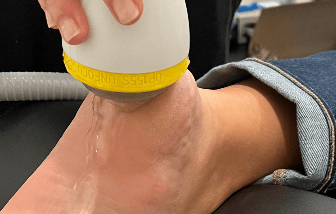 Achilles Tendonitis Pain Relief with SoftWave Therapy at Nathans Family Chiropractic
